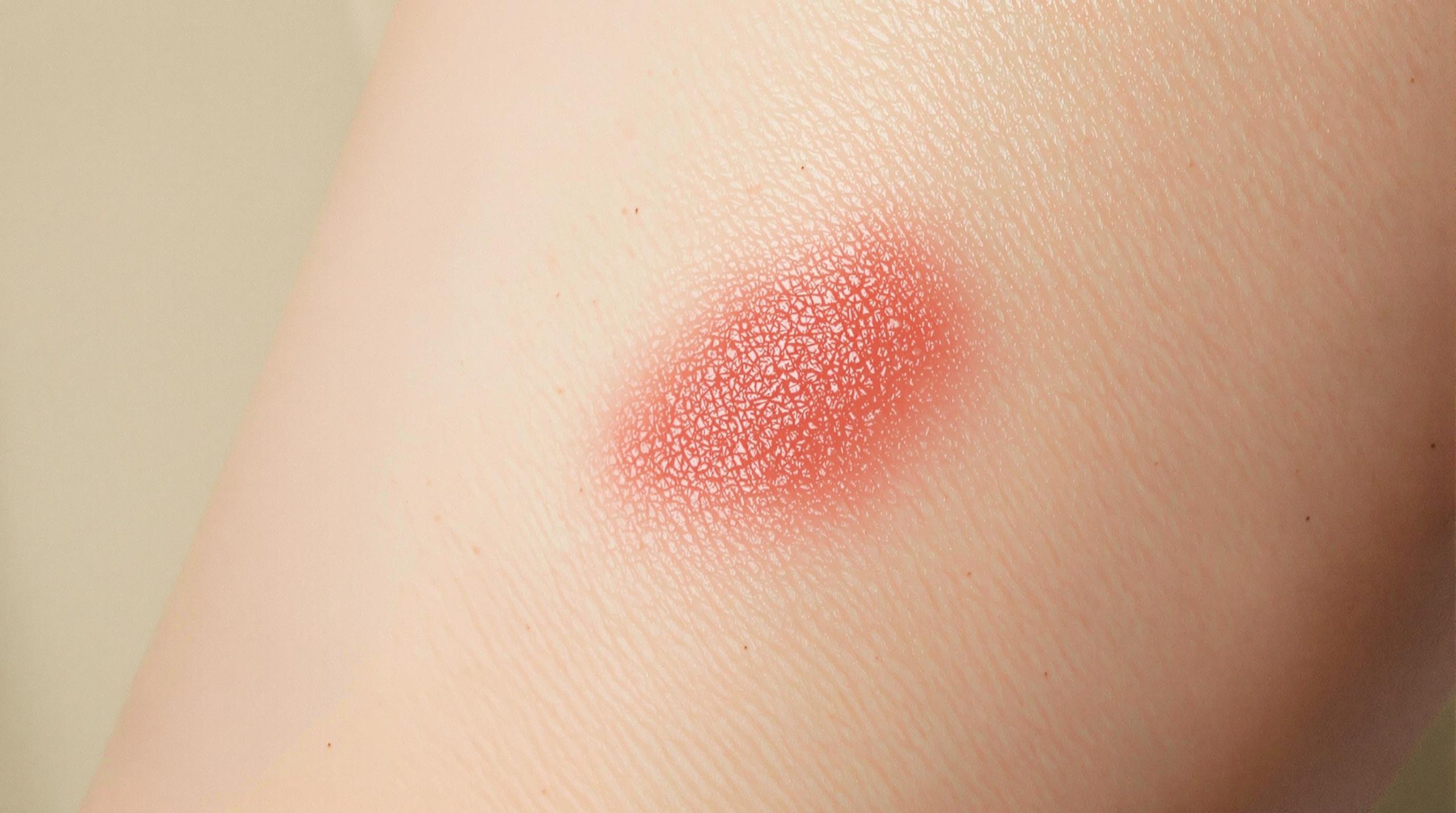 Cicatrice boursouflée après opération : causes, traitements et conseils - Voyage Inspire